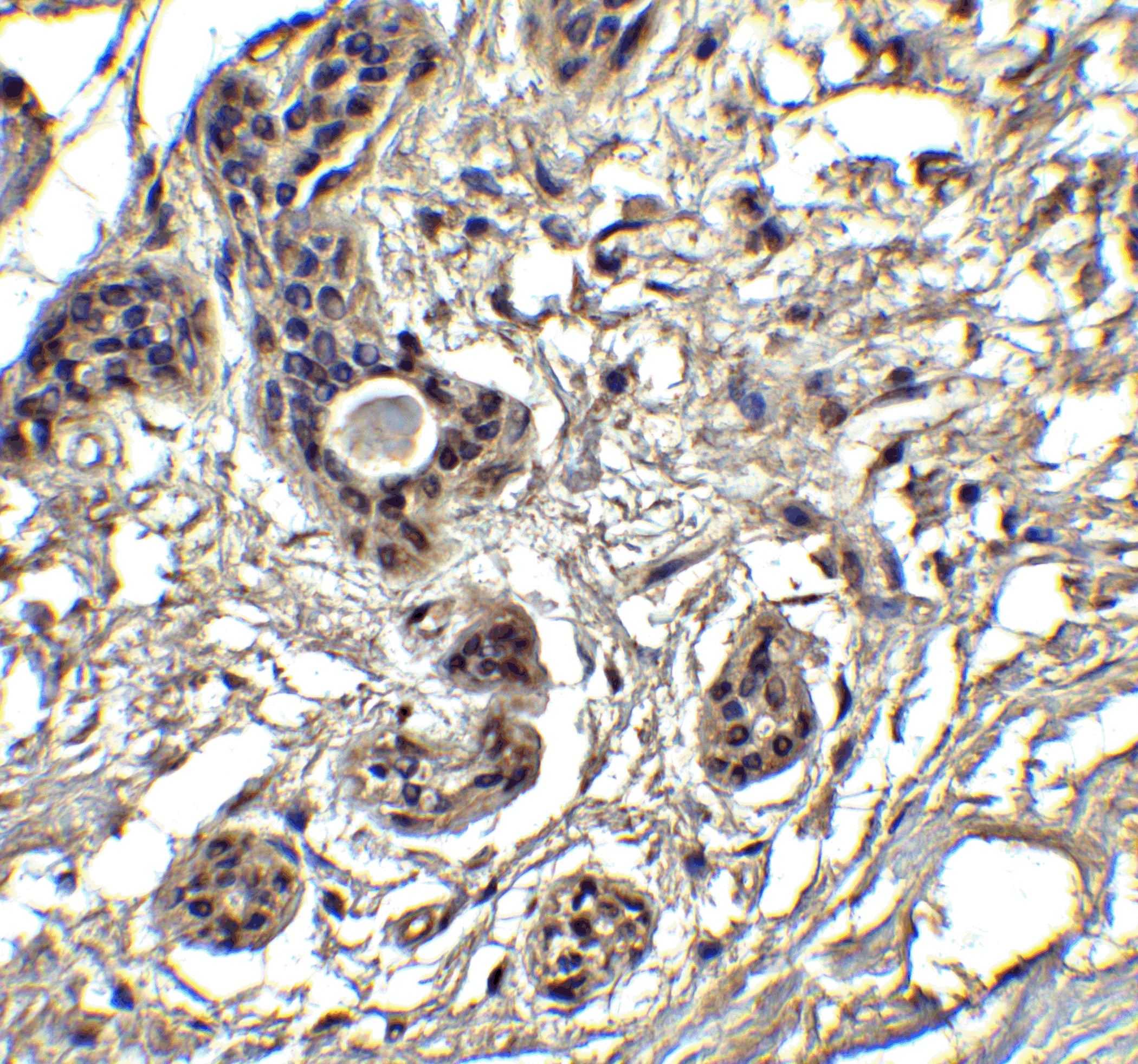 Immunohistochemistry: PUMA Antibody - BSA Free [NBP1-76639] -  Validation of PUMA in Human Breast Tissue.   Immunohistochemical analysis of paraffin-embedded human breast tissue using anti-PUMA antibody  at 2.5 ug/ml. Tissue was fixed with formaldehyde and blocked with 10% serum for 1 h at RT; antigen retrieval was by heat mediation with a citrate buffer (pH6). Samples were incubated with primary antibody overnight at 4C. A goat anti-rabbit IgG H&L (HRP) at 1/250 was used as secondary. Counter stained with Hematoxylin.