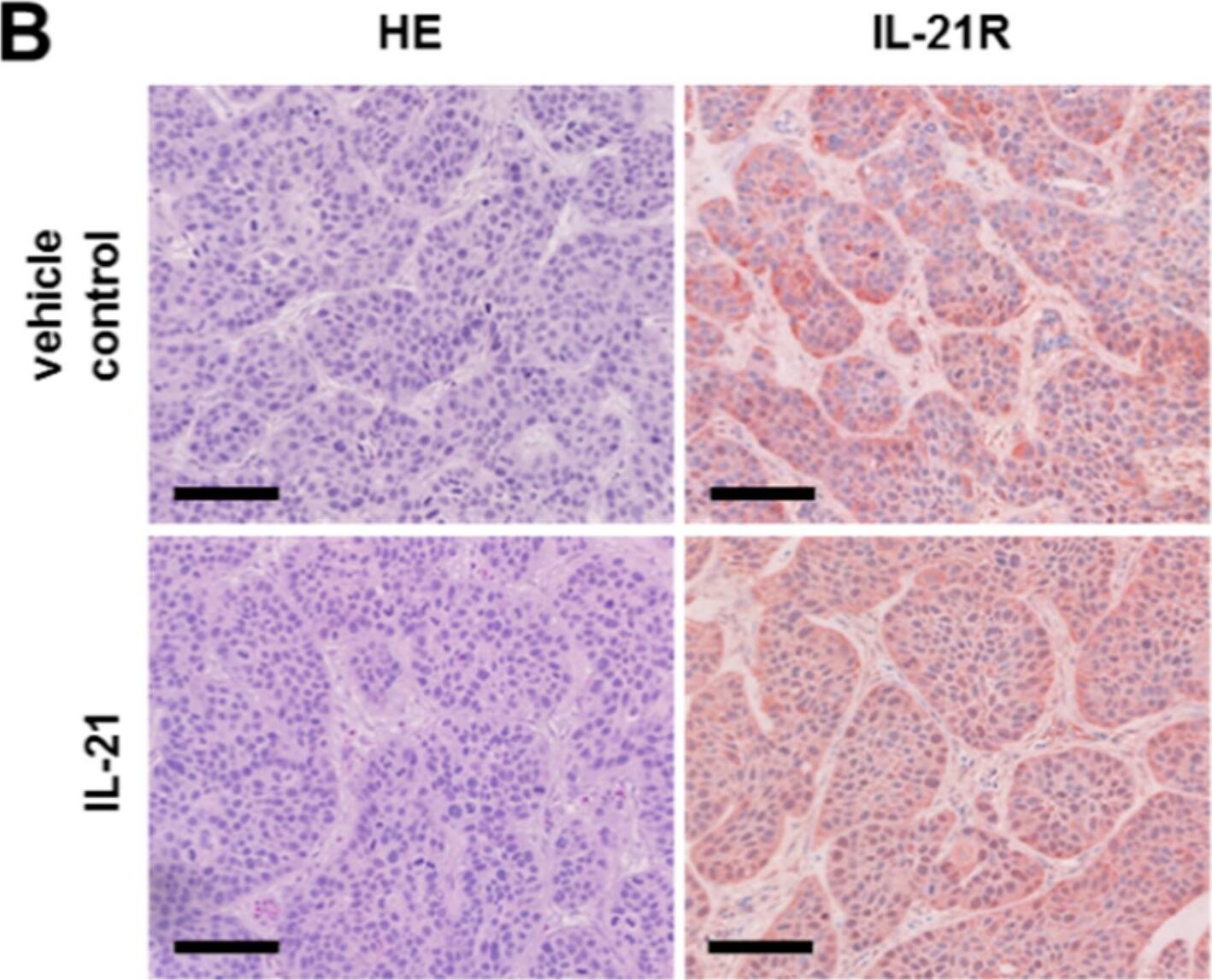 Immunohistochemistry: IL-21R Antibody - BSA Free [NBP1-76739] - Treatment of avian xenografts with IL-21 upregulates Blimp-1 expression. (A) The three-dimensional growth of BxPC-3 cells transplanted on the CAM of fertilized chicken eggs & resected tumors (three replicates) from vehicle control & IL-21 were photographed at day 17 of embryonic development. Upper row for vehicle control; lower row for IL-21-treated (150 ng/mL) tumors. (B) HE & IL-21R (brown) IHC staining of vehicle control & IL-21-treated (150 ng/mL) resected xenograft tumors. (C) Comparison & quantification of Blimp-1 (nuclei: red) expression of vehicle control & IL-21-treated (150 ng/mL) xenograft tumors. **** P < 0.0001. Unpaired t-test. Image collected & cropped by CiteAb from the following publication (//pubmed.ncbi.nlm.nih.gov/31540511), licensed under a CC-BY license. Not internally tested by Novus Biologicals.