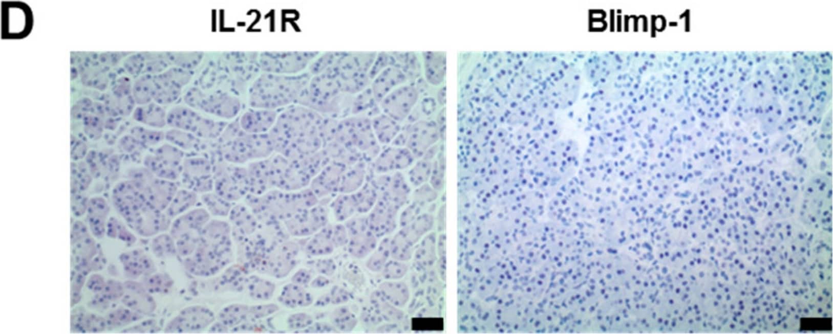 Immunohistochemistry: IL-21R Antibody - BSA Free [NBP1-76739] - IL-21R, IL-21, & Blimp-1 expression in human PDAC & healthy pancreas tissue samples. (A) Infiltration of IL-21+ immune cells (red) in PDAC. Black arrow: IL-21+ cells. (B) Infiltration of IL-21+ Th17 cells in PDAC: IL-21+ (red) & RORC+ (brown) cells. Black arrowhead: PDAC tumor cells, black arrow: IL-21+/RORC+ immune cells. (C) Examples of negative, weak & high expression of IL-21R (brown) & Blimp-1 (red) in human PDAC tissue. Black arrows: tumor cells. (D) Examples of IL-21R & Blimp-1 expression in healthy pancreas tissue. (E) IL-21R expression in human PDAC varied among the patients. (F) Association of IL-21R & Blimp-1 expression in human PDAC. * P < 0.05 & **** P < 0.0001. Unpaired t-test. (G) Co-expression of IL-21R (brown, membrane) & Blimp-1 (red, nucleus). Black arrowhead: IL-21R+/Blimp-1+, white arrow head: IL-21R+/Blimp-1−. Black bar: 20 µm. Image collected & cropped by CiteAb from the following publication (//pubmed.ncbi.nlm.nih.gov/31540511), licensed under a CC-BY license. Not internally tested by Novus Biologicals.