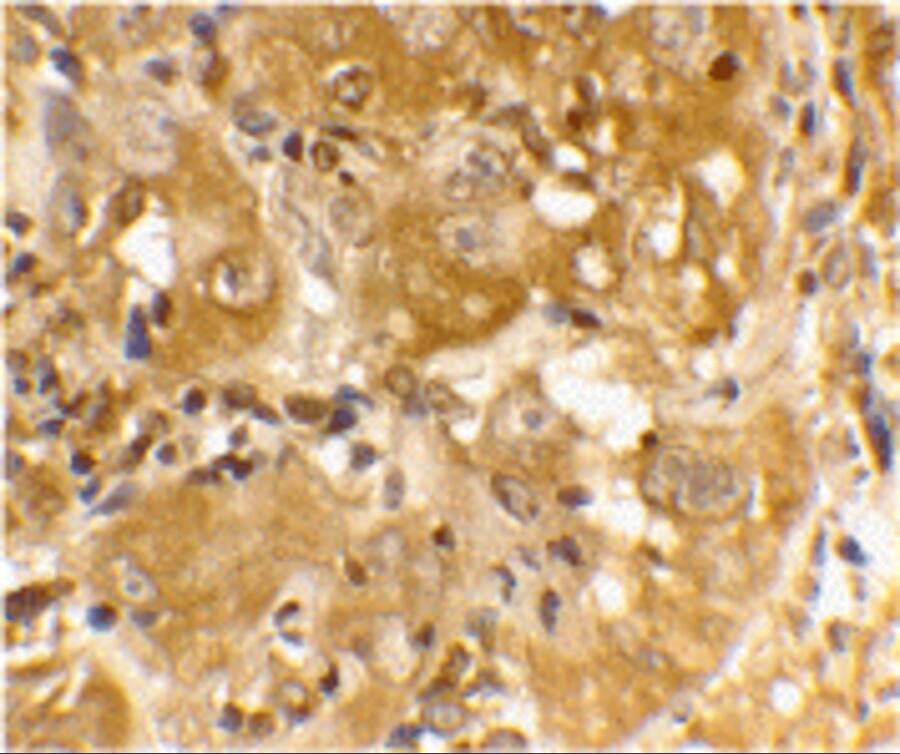 Immunohistochemistry: Bim Antibody - BSA Free [NBP1-76963] - Figure 7 Immunohistochemistry Validation of BIM in Human Skin Cancer Cells Immunohistochemical analysis of paraffin-embedded human spleen tissue using anti-BIM antibody  at 20 u/ml. Tissue was fixed with formaldehyde and blocked with 10% serum for 1 h at RT; antigen retrieval was by heat mediation with a citrate buffer (pH6). Samples were incubated with primary antibody overnight at 4C. A goat anti-rabbit IgG H&L (HRP) at 1/250 was used as secondary. Counter stained with Hematoxylin.