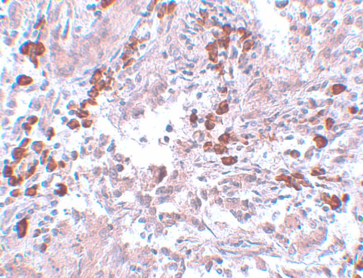 Immunohistochemistry: BCAS1 Antibody - BSA Free [NBP1-77123] - Immunohistochemistry of BCAS1 in human breast carcinoma with BCAS1 antibody at 5 u/mL.