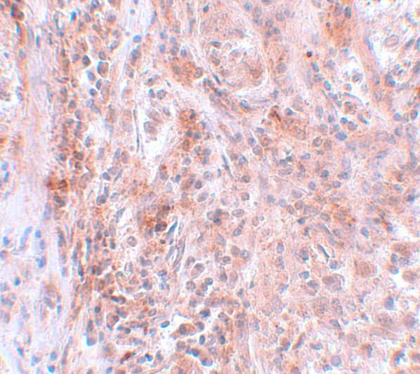 Immunohistochemistry: BCAS2 Antibody - BSA Free [NBP1-77124] - Immunohistochemistry of BCAS2 in human breast carcinoma with BCAS2 antibody at 5 u/mL.