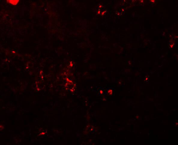 Immunocytochemistry/ Immunofluorescence: BCAS2 Antibody - BSA Free [NBP1-77124] - Immunofluorescence of BCAS2 in human breast carcinoma tissue with BCAS2 antibody at 20 u/mL.