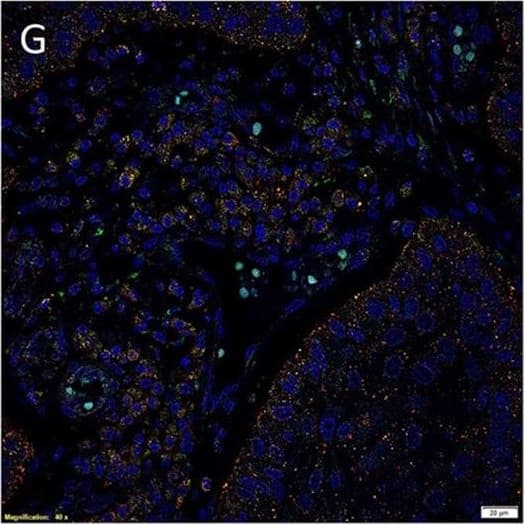 Immunocytochemistry/ Immunofluorescence: AGTR-2 Antibody - BSA Free [NBP1-77368] - Representative immunofluorescent immunohistochemical-stained sections of moderately differentiated buccal mucosal squamous cell carcinoma demonstrating PRR [(A), red] was expressed by cells within the tumor nests that stained positively for EMA [(A), green]. PRR [(B), red] was also expressed by the CD34+ [(B), green] endothelium of the microvessels. In addition, RRR [(C), red] was expressed by cells within the peri-tumoral stroma, which also expressed OCT4 [(C), green]. ACE [(D), green] was expressed on the endothelium of the microvessels, which also expressed SOX2 [(D), red], within the peri-tumoral stroma. Cytoplasmic expression of ATIIR1 [(E), green] & PRR [(E), red] was demonstrated in cells within the tumor nests, the peri-tumoral stroma, & the endothelium of the microvessels within the peri-tumoral stroma. ATIIR2 [(F,G), red] was expressed by cells within the tumor nests that expressed SALL4 [(F), green] & OCT4 [(G), green]. Cell nuclei were counterstained with 4′,6′-diamidino-2-phenylindole [(A–G), blue]. Scale bars: 20 μm. Image collected & cropped by CiteAb from the following publication (//pubmed.ncbi.nlm.nih.gov/27730124), licensed under a CC-BY license. Not internally tested by Novus Biologicals.