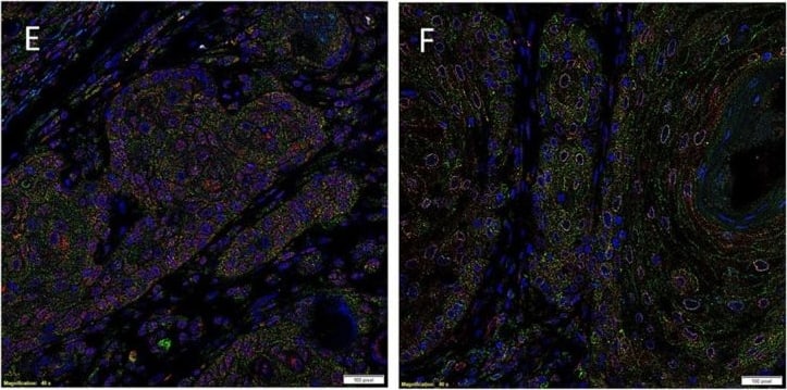 Immunocytochemistry/ Immunofluorescence: AGTR-2 Antibody - BSA Free [NBP1-77368] - Representative immunofluorescent immunohistochemical-stained sections of moderately differentiated lip squamous cell carcinoma demonstrating expression of (pro)renin receptor (PRR) [(A,B), red] by cells within the tumor nests (TNs) & the cells within the stroma that expressed SALL4 [(A), green]. PRR was also expressed by cells within the stroma that expressed OCT4 [(B), green]. Angiotensin-converting enzyme (ACE) [(C), green] was expressed on the endothelium of the microvessels which expressed SOX2 [(C), red], within the stroma. Staining with ETS-related gene [(G), red] confirmed that ACE [(G), green] was expressed by the endothelium of the microvessels within the stroma. Angiotensin II receptor 1 [(D), green] was demonstrated in cells within the TNs & occasional microvessels that stained positively for SOX2 [(D), red]. Angiotensin II receptor 2 [(E,F), red] was expressed by cells within the TNs, & cells within the stroma that expressed SALL4 [(E), green] & those that expressed OCT4 [(F), green]. Cell nuclei were counterstained with 4′,6′-diamidino-2-phenylindole [(A–G), blue]. Scale bars: 20 µm. Image collected & cropped by CiteAb from the following publication (//journal.frontiersin.org/article/10.3389/fsurg.2017.00030/full), licensed under a CC-BY license. Not internally tested by Novus Biologicals.