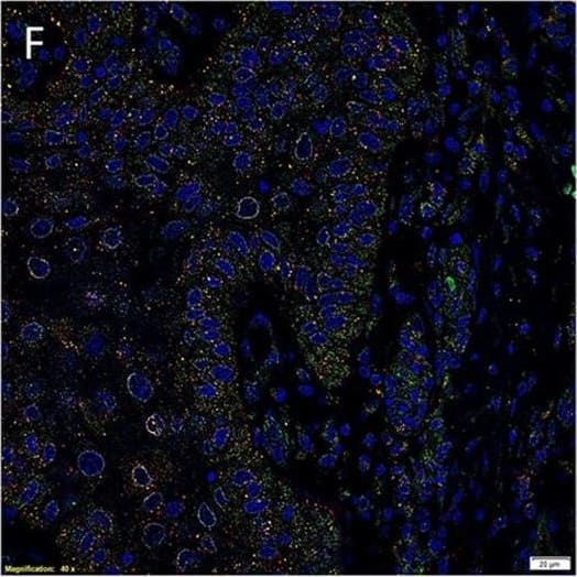 Immunocytochemistry/ Immunofluorescence: AGTR-2 Antibody - BSA Free [NBP1-77368] - Representative immunofluorescent immunohistochemical-stained sections of moderately differentiated buccal mucosal squamous cell carcinoma demonstrating PRR [(A), red] was expressed by cells within the tumor nests that stained positively for EMA [(A), green]. PRR [(B), red] was also expressed by the CD34+ [(B), green] endothelium of the microvessels. In addition, RRR [(C), red] was expressed by cells within the peri-tumoral stroma, which also expressed OCT4 [(C), green]. ACE [(D), green] was expressed on the endothelium of the microvessels, which also expressed SOX2 [(D), red], within the peri-tumoral stroma. Cytoplasmic expression of ATIIR1 [(E), green] & PRR [(E), red] was demonstrated in cells within the tumor nests, the peri-tumoral stroma, & the endothelium of the microvessels within the peri-tumoral stroma. ATIIR2 [(F,G), red] was expressed by cells within the tumor nests that expressed SALL4 [(F), green] & OCT4 [(G), green]. Cell nuclei were counterstained with 4′,6′-diamidino-2-phenylindole [(A–G), blue]. Scale bars: 20 μm. Image collected & cropped by CiteAb from the following publication (//pubmed.ncbi.nlm.nih.gov/27730124), licensed under a CC-BY license. Not internally tested by Novus Biologicals.