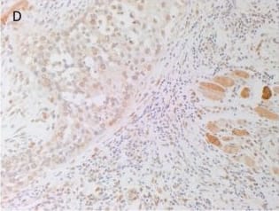 Immunohistochemistry: AGTR-2 Antibody - BSA Free [NBP1-77368] - Representative 3,3-diaminobenzidine immunohistochemical-stained sections of moderately differentiated lip cancer samples showing cytoplasmic expression of (pro)renin receptor [(A), brown] within the tumor nests (TNs) & cells within the stroma. Angiotensin-converting enzyme [(B), brown] was expressed on the endothelium of the microvessels within the stroma but not the TNs. Angiotensin II receptor 1 [(C), brown] showed weak to moderate cytoplasmic & nuclear staining by cells within the TNs & cells within the stroma. Strong perinuclear & cytoplasmic staining for angiotensin II receptor 2 [(D), brown] was present in cells within the TNs & the stroma, & skeletal tissue. Nuclei were counterstained with hematoxylin [(A–D), blue]. Original magnification: 200×. Image collected & cropped by CiteAb from the following publication (//journal.frontiersin.org/article/10.3389/fsurg.2017.00030/full), licensed under a CC-BY license. Not internally tested by Novus Biologicals.