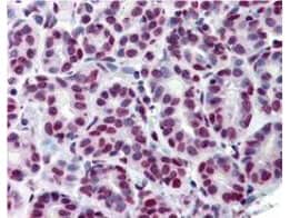 Immunohistochemistry of Monoclonal Anti-Stat5 pY694 Antibody. Tissue: human breast tissue (40X).  Fixation: formalin fixed paraffin embedded (FFPE). Antigen retrieval: steam sections in 0.1 M sodium citrate buffer, pH 6, for 20 min. Rinse with 1XTBST. Primary antibody: Anti-Stat5pY694 at 20 ug/mL. Localization: breast epithelium with moderate nuclear staining. Staining: Stat5 pY694 as precipitated red signal, with a hematoxylin purple nuclear counterstain. Personal communication, Andrew Elston, Lifespan Biosciences, Seattle, WA.