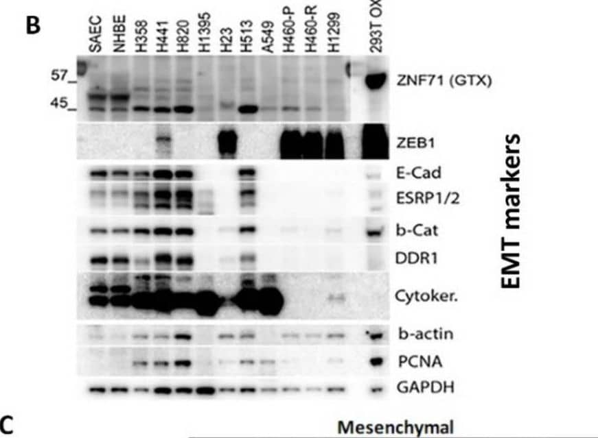 ZNF71 isoforms in epithelial-to-mesenchymal transition (EMT) and patient survival. (A) Relative quantity of ZNF71, KRAB, and KRAB-less in qRT-PCR assays of NSCLC cell lines. (B) Western blots of EMT markers as well as endogenous ZNF71 and overexpressed ZNF71 in HEK-293T (top lanes). (C) EMT classification of NSCLC tumors based on the average expression rank of epithelial and mesenchymal markers. The table shows the final four phenotype categorization of patient samples. (D) The expression of 14 EMT markers in patient tumors grouped by four phenotypes defined in D. (E–I) Kaplan–Meier survival analyses of patient tumors grouped by four EMT phenotypes (E) and in each phenotype (F–I). The Epithelial phenotype had the best patient survival outcome, and the High expression overlap phenotype had the worst patient survival outcome; ZNF71 KRAB is a poor prognosis marker in both phenotypes. Image collected and cropped by CiteAb from the following open publication (//pubmed.ncbi.nlm.nih.gov/33916522), licensed under a CC-BY license. Not internally tested by Novus Biologicals.