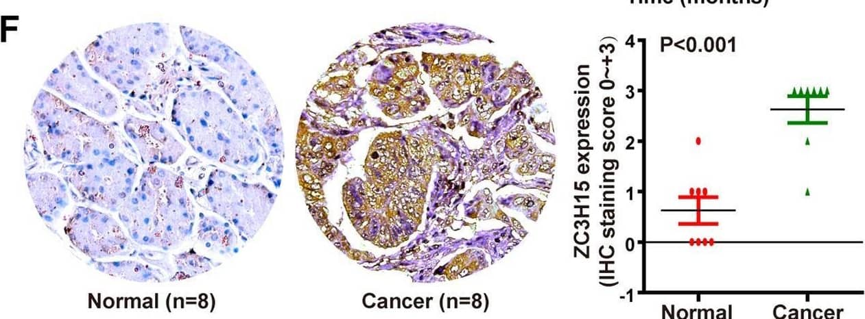 ZC3H15 was upregulated in GC and high expression of ZC3H15 was correlated with poor patient prognosis.A Up-regulation of ZC3H15 was found in 8 of 20 cancer types. B, C The level of ZC3H15 mRNA was significantly increased from normal stomach tissues to gastric cancer tissues in DErrico and Cho dataset and P-values were indicated. D, E Kaplan–Meier analysis of overall survival using data from the GSE14210 and GSE15459 database and P-values were indicated. F Immunohistochemical analyses of ZC3H15 expression in eight paired samples of gastric cancer and normal stomach tissue, P < 0.001. The data were expressed as mean +/- SD. Student’s t-test was performed to analyze significance. G Western blot analyses were used to examine ZC3H15 expression in GES-1 cells and gastric cancer cell lines. Image collected and cropped by CiteAb from the following open publication (//pubmed.ncbi.nlm.nih.gov/35064102), licensed under a CC-BY license. Not internally tested by Novus Biologicals.