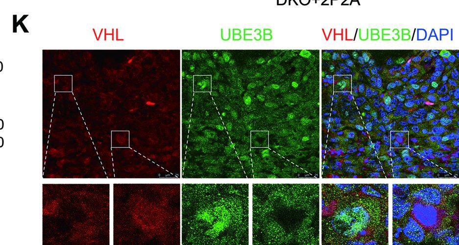 VHL-mediated UBE3B ubiquitination is essential for VHL in suppressing breast tumor growth and metastasis.A–C Tumor images (A), tumor growth curves (B), and tumor weight (C) of mice bearing DKO+2P2A + Myc-UBE3B-WT, DKO+2P2A + Myc-UBE3B-DM, DKO+2P2A + Myc-UBE3B-WT+Flag-VHL, and DKO+2P2A + Myc-UBE3B-DM+Flag-VHL T47D tumors (mean +/- SD, n = 5). ****P < 0.0001, by 2-way ANOVA Tukey’s multiple comparisons test (B) or 1-way ANOVA Tukey’s multiple comparisons test (C). D–G Representative H&E and immunohistochemical staining of Ki-67, CC3, and endomucin in primary tumors. Scale bars: 100 μm. Ki-67-positive cell numbers (E), CC3-positive cell numbers (F), and microvessel density (G) were quantified. (mean +/- SD, n = 5). ***P < 0.001, ****P < 0.0001, by 1-way ANOVA Dunnett’s multiple comparisons test. ns no significance. H, I DKO+2P2A + Myc-UBE3B-WT, DKO+2P2A + Myc-UBE3B-DM, DKO+2P2A + Myc-UBE3B-WT+Flag-VHL, and DKO+2P2A + Myc-UBE3B-DM+Flag-VHL MDA-MB-231 cells were injected into mice through tail vein. Representative H&E-stained lung sections (H) and quantification of lung metastases by qPCR (I) (mean +/- SD, n = 4). ****P < 0.0001, 1-way ANOVA Tukey’s multiple comparisons test. Scale bars: 500 μm. J Immunoblots of lysates from paired normal (N) and breast cancer tissues (T). K Immunostaining of UBE3B and VHL in human breast cancer tissues. Scale bars: 25 μm. Image collected and cropped by CiteAb from the following open publication (//pubmed.ncbi.nlm.nih.gov/38914543), licensed under a CC-BY license. Not internally tested by Novus Biologicals.