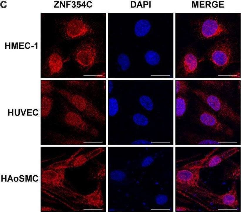 Zinc Finger Protein 354C (ZNF354C) overexpression leads to inhibition of sprouting in HMEC-1. (a) RNA expression level as measured with RT-qPCR of ZNF354C in different cell types. Data is normalised to HUVEC batch 1 (set as 1) and to b-actin. n = 3. Data are mean +/- SEM. (b) Representative western blot of HUVEC, HMEC-1 and HAoSMC. ZNF354C antibody was used. HSC70/HSP70 antibodies served as loading control. (c) Immunofluorescence with an antibody against ZNF354C in HMEC-1, HUVEC and HAoSMC. Nuclei were stained with DAPI. Scale bar indicates 20 um. (d) RT-qPCR of ZNF354C after overexpression (OE) of pCMV6-ZNF354C (354C) in HMEC-1, HUVEC and HAoSMC. PCMV6-entry was used as negative control (CTL). Data is normalized to b-actin. n = 5. Data are mean +/- SEM. Mann–Whitney t-test; *P < 0.05. (e) Representative western blot of untreated (native) HMEC-1, HUVEC and HAoSMC or after overexpression of pCMV6-ZNF354C (ZNF354C) or pCMV6-entry (CTL). ZNF354C, Flag or b-actin antibodies were used. (f) Immunofluorescence with an antibody against ZNF354C in HMEC-1 after overexpression of pCMV6-ZNF354C or pCMV6-entry. Nuclei were stained with DAPI. Scale bar indicates 20 um. (g, h) Spheroid outgrowth assay quantification of sprout number (g) and cumulative sprout length (h) after overexpression of pCMV6-ZNF354C (354C) or pCMV6-entry (NC). Cells were studied under basal conditions or after treatment with VEGF-A or TNF-alpha . Scale bar indicates 50 um. n = 13. One-Way ANOVA with Bonferroni post-hoc test. *P < 0.05. Image collected and cropped by CiteAb from the following open publication (//pubmed.ncbi.nlm.nih.gov/33154469), licensed under a CC-BY license. Not internally tested by Novus Biologicals.