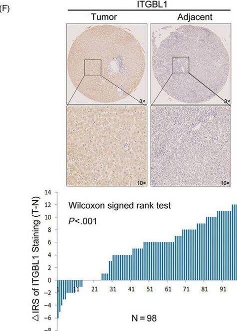 ITGBL1 expression is upregulated in HCC tissues and associated with the prognosis of HCC patients. A, ITGBL1 expression in the normal liver tissues (n = 50) and primary liver tumour tissues (n = 371), as revealed by the TCGA HCC data set (P < .001). B, ITGBL1 expression in the normal liver (n = 19) and HCC tissues (n = 47), as revealed by the Oncomine database (GSE14323; P < .001). C, Different ITGBL1 mRNA expression levels in 22 paired samples of HCC tumour tissues and adjacent non‐cancerous tissues, as determined by RT‐PCR analyses (P = .0057). D, Western blotting analyses of the ITGBL1 protein expression levels in eight randomly selected tumour tissues and the matched adjacent non‐tumour tissues from HCC patients; GAPDH was used as the internal loading control. E, Greyscale analysis of the ITGBL1 expression level, compared to the GAPDH expression level, in the eight patients (P < .001). T, tumour tissue; N, normal tissue. F, Immunochemistry staining of ITGBL1 in the TMAs with HCC tissues and adjacent non‐cancerous tissues (n = 98; P < .001). G, The Kaplan‐Meier plot for the overall survival of HCC patients according to ITGBL1 expression levels (higher vs lower, log‐rank test, P = .014) Image collected and cropped by CiteAb from the following open publication (//pubmed.ncbi.nlm.nih.gov/32537856), licensed under a CC-BY license. Not internally tested by Novus Biologicals.