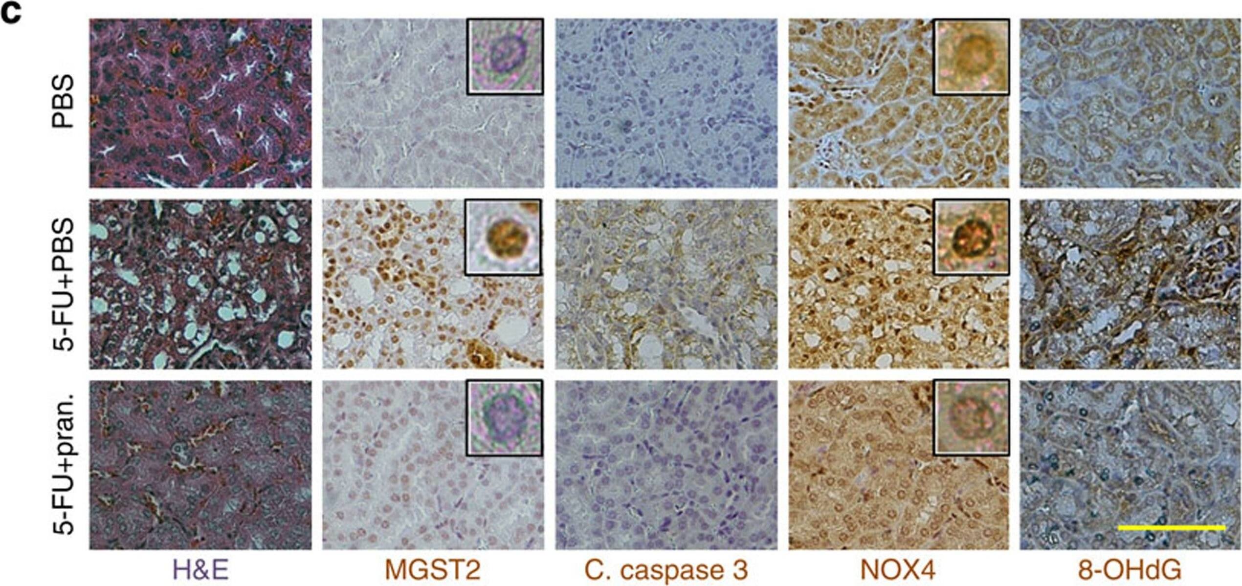Mgst2 deficiency and LTC4 inhibition attenuate 5-FU-triggered DNA damage and toxicity.(a) Survival of WT and Mgst2-deficient mice (10 per group) given 5-FU (300 mg kg−1, ip) at time=0. P=0.0085. (b) Survival of WT 129/Sv mice (18 per group) treated with 5-FU as in a. Vehicle or pranlukast (1 mg kg−1) were administered at days 0, 1, 2, 5, 6 and 7. P=0.032. The statistical significance was determined in a and b using the Gehan–Breslow–Wilcoxon test. (c) Haematoxylin–eosin (H&E) stain and immunostain of the indicated proteins and 8-OHdG in kidney slices of WT mice treated with 5-FU (300 mg kg−1, ip at time=0) followed by five administrations of PBS or pranlukast (Pran., 3 mg kg−1, ip) as in b. Kidneys were processed at day 13. Bar, 50 μm. Insets: enlarged images showing immunostained nuclei. The images of kidney slices are representatives of slices from three mice per group. (d) Survival of U266 myeloma cells treated with bortezomib alone or together with the indicated LTC4 inhibitors (10 μM each). n=3. (e) Survival of CCRF-CEM T-cell leukaemia lymphoblasts treated with doxorubicin together with the indicated LTC4 inhibitors (10 μM each). n=3. No significant differences were found between vehicle and any of the inhibitors in d and e. Statistical significance was determined using one-way ANOVA. Image collected and cropped by CiteAb from the following open publication (//pubmed.ncbi.nlm.nih.gov/26656251), licensed under a CC-BY license. Not internally tested by Novus Biologicals.