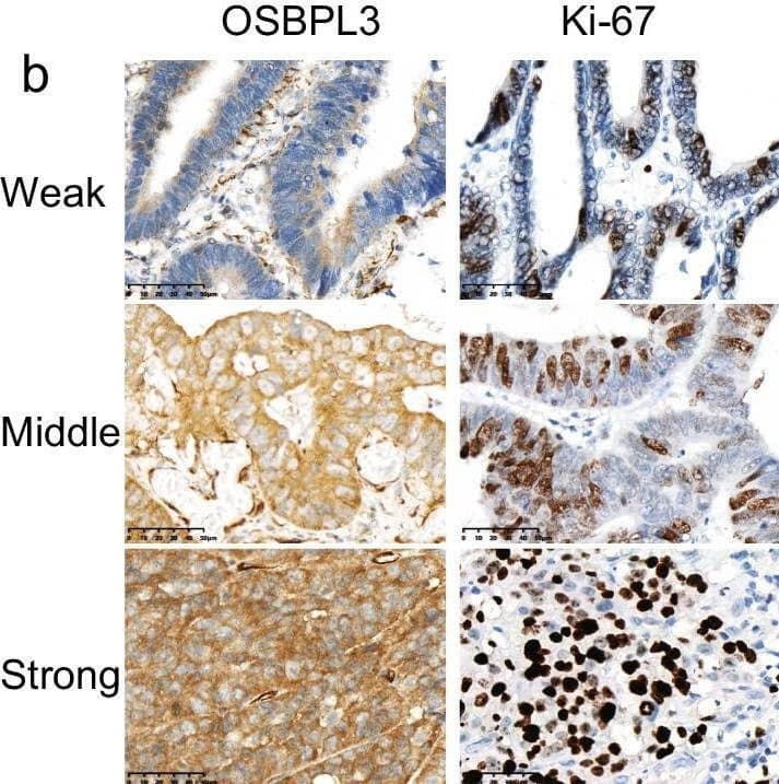 Expression of OSBPL3 and Ki-67 in CRC samples detected by immunohistochemistry. a The pie chart shows the number of co-expression OSBPL3 and ki-67 in CRC samples. b Representative image of OSBPL3 and ki-67 score from weak to strong on normal intestinal epithelium and tumor tissues. Staining location: OSBPL3 staining is located in the nucleus and cytoplasm, and Ki-67 staining is located in the nucleus. The expression of Ki-67 was also weak in tissues with weak OSBPL3 expression; Ki-67 expression was also strong in tissues with strong expression of OSBPL3 (Magnification × 400) Image collected and cropped by CiteAb from the following open publication (//pubmed.ncbi.nlm.nih.gov/36517805), licensed under a CC-BY license. Not internally tested by Novus Biologicals.