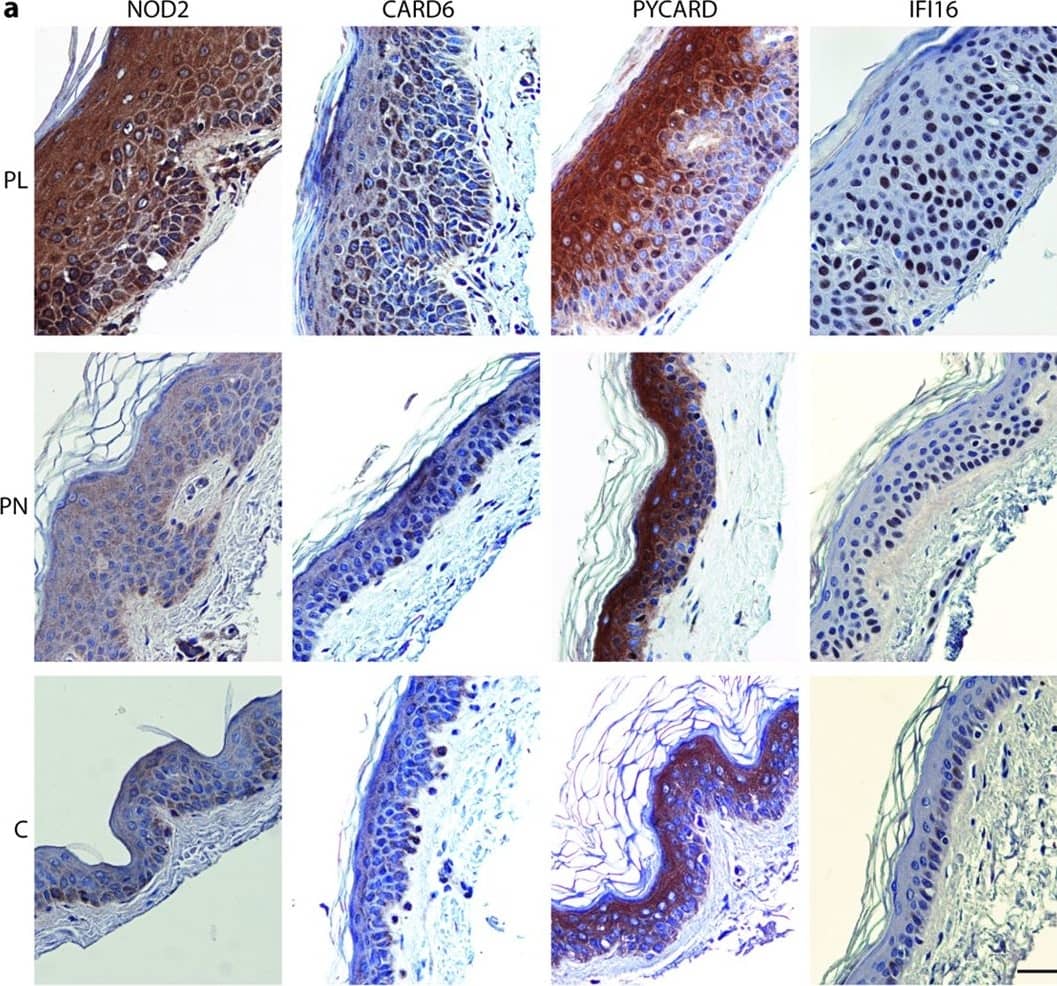 Immunohistochemistry-Paraffin: IFI16 Antibody [NBP1-83118] - Induced expression of NOD2, CARD6, PYCARD, & IFI16 in psoriasis lesions.(a) Immunohistochemistry shows stronger NOD2, CARD6, PYCARD, & IFI16 staining in PL (upper) than in controls (lower). PN (middle) & C are almost negative for NOD2 & CARD6. IFI16 is predominantly in nuclei of PL & PN. In controls IFI16 expression is weak & cytoplasmic. PYCARD is strongly induced in cytoplasm but also some nuclei are positive in PL & PN. Controls exhibit only a few PYCARD positive nuclei. Scale bar 50 μm. (b) IEM of PL shows PYCARD clusters in cytoplasm. (c) Immunofluorescence of keratinocytes colocalizes CARD6 with a mitochondrial MTCO2. (d) IEM of psoriatioc lesional samples also localized CARD6 in the mitochondria (arrow head). Image collected & cropped by CiteAb from the following publication (//pubmed.ncbi.nlm.nih.gov/26976200), licensed under a CC-BY license. Not internally tested by Novus Biologicals.