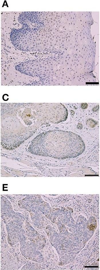 Immunohistochemistry: CLPTM1L Antibody [NBP1-84378] - Representative Immunohistochemical staining according to Cleft Lip & Palate Transmembrane 1-Like (Clptm1L) & TMEM207 immunoreactivity at the invasion front of oral squamous cell carcinoma (OSCC). Weak Clptm1L or TMEM207 immunoreactivity was found in non-tumorous oral epithelial cells (A,B), respectively. In contrast, Clptm1L or TMEM207 immunoreactivity was found in many invasive OSCC cells. Representative positive Clptm1L immunoreactivity in tissue specimens from patients with favorable & poor prognosis is shown in (C,D), respectively. TMEM207 immunoreactivity in tissue specimens from patients with favorable & poor prognosis is shown in (E,F), respectively. Note the robust Clptm1L & TMEM207 immunoreactivity in (D,F). Image collected & cropped by CiteAb from the following publication (//pubmed.ncbi.nlm.nih.gov/35047994), licensed under a CC-BY license. Not internally tested by Novus Biologicals.