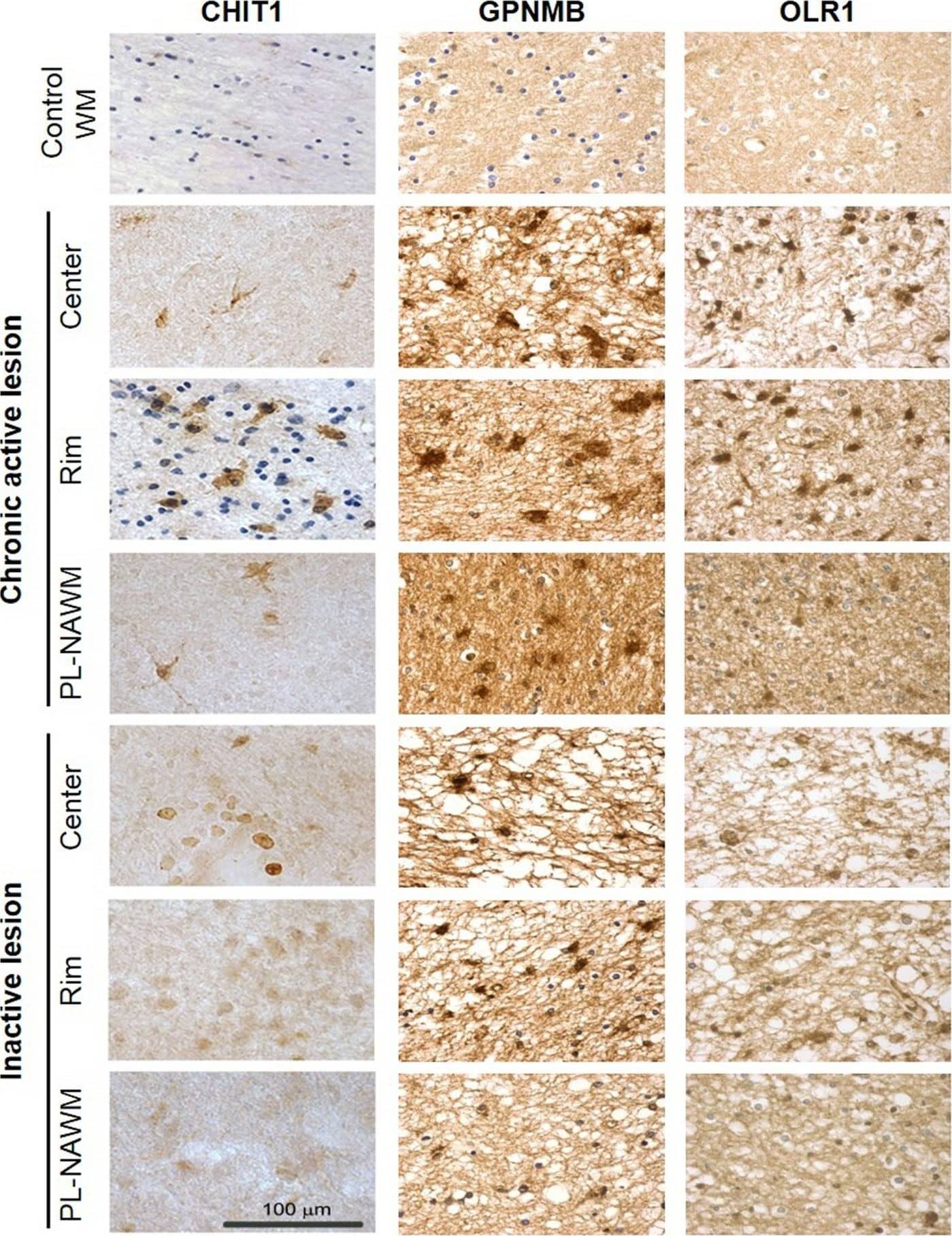 Expression of CHIT1, GPNMB, and OLR1 in and around multiple sclerosis (MS) lesions. Protein expression of CHIT1, GPNMB, and OLR1 in control tissue and in the center, rim, and peri-lesional (PL)-normal appearing white matter (NAWM) of chronic active and inactive MS lesions determined by immunohistochemistry. Scale bar = 100 µm.