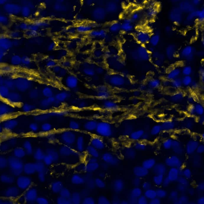 Versican was detected in immersion fixed paraffin-embedded sections of human brain Glioblastoma using Rabbit Anti-Human Versican Monoclonal Antibody (Catalog # NBP1-85432) at 10ug/mL at 37 ° Celsius for 8 minutes. Before incubation with the primary antibody, tissue underwent an all-in-one dewaxing and antigen retrieval preprocessing using PreTreatment Module (PT Module) and Dewax and HIER Buffer H (pH 9; Epredia Catalog # TA-999-DHBH). Tissue was stained using the Alexa Fluor™ Plus 555 Goat anti-Rabbit IgG Secondary Antibody at 1:100 at 37 ° Celsius for 2 minutes. (Yellow; Lunaphore Catalog # <A class=