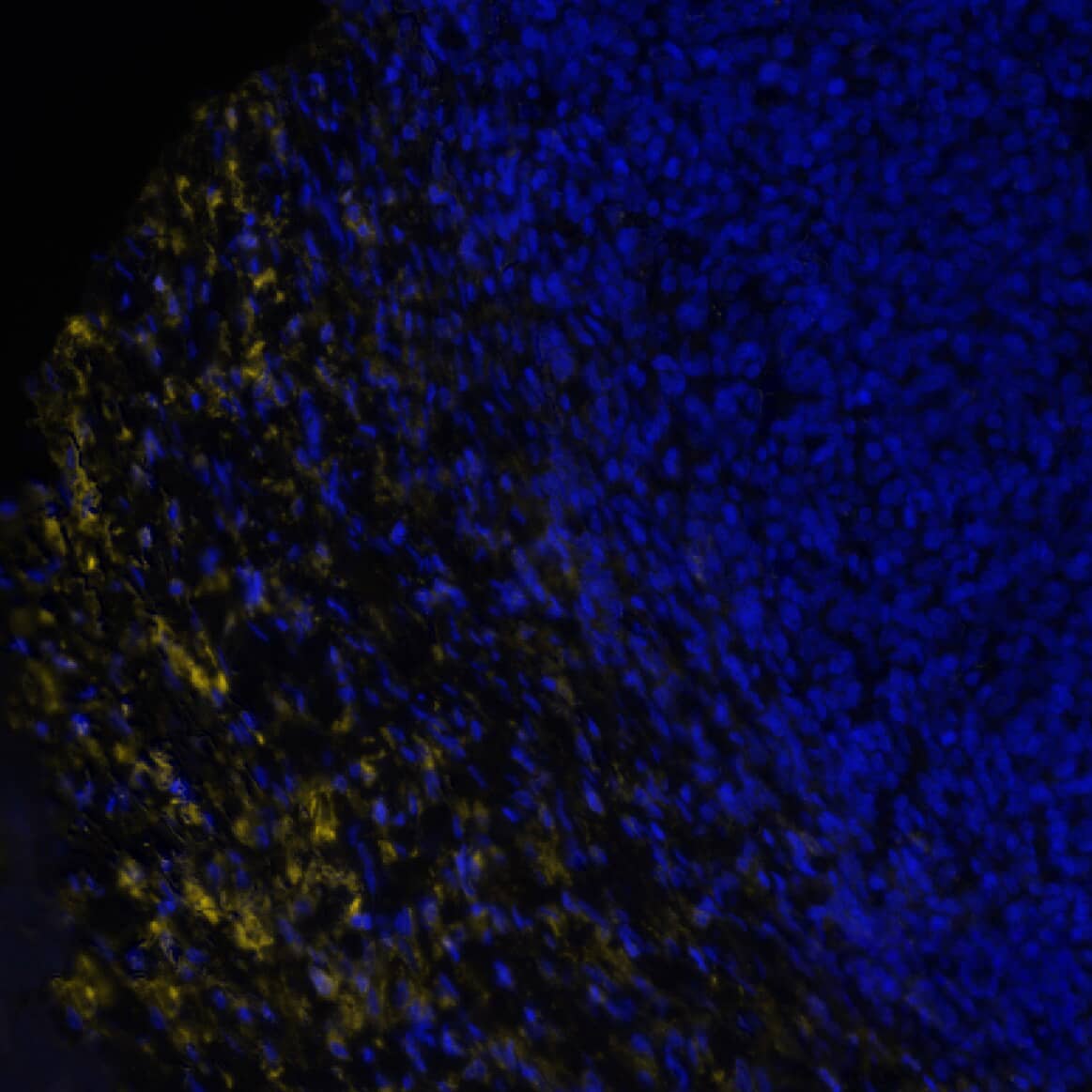 Versican was detected in immersion fixed paraffin-embedded sections of human B-Cell Lymphoma using Rabbit Anti-Human/Mouse Versican, Polyclonal Antibody (Catalog #  NBP1-85432) at 10ug/mL at 37° Celsius for 8 minutes. Before incubation with the primary antibody, tissue underwent an all-in-one dewaxing and antigen retrieval preprocessing using PreTreatment Module (PT Module) and Dewax and HIER Buffer H (pH 9; Epredia Catalog # TA-999-DHBH). Tissue was stained using the Alexa Fluor™ Plus 555 Goat anti-Rabbit IgG Secondary Antibody at 1:100 at 37 ° Celsius for 2 minutes. (Yellow; Lunaphore Catalog # <A class=