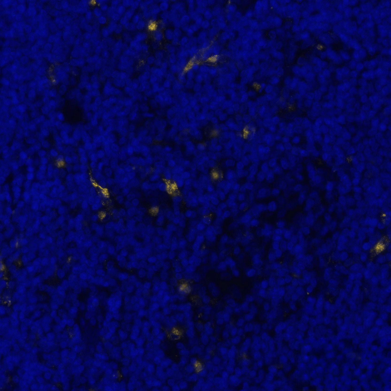 Versican was detected in immersion fixed paraffin-embedded sections of human Hodgkin Lymphoma using Rabbit Anti-Human/Mouse Versican, Polyclonal Antibody (Catalog # NBP1-85432) at 10ug/mL at 37° Celsius for 8 minutes. Before incubation with the primary antibody, tissue underwent an all-in-one dewaxing and antigen retrieval preprocessing using PreTreatment Module (PT Module) and Dewax and HIER Buffer H (pH 9; Epredia Catalog # TA-999-DHBH). Tissue was stained using the Alexa Fluor™ Plus 555 Goat anti-Rabbit IgG Secondary Antibody at 1:100 at 37 ° Celsius for 2 minutes. (Yellow; Lunaphore Catalog # <A class=