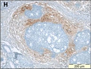 Immunohistochemistry: Versican Antibody [NBP1-85432] - Immunohistochemical staining of stromal protein expression in DCIS with sclerotic or myxoid stromaMicrophotographs displaying HE staining (A-B), & IHC staining for biglycan (C-D), decorin (E-F) & versican (G-H). Panels A-C-E-G display photographs of one DCIS lesion with sclerotic stroma; panels B-D-F-H display one DCIS lesion with myxoid stroma. This figure illustrates that myxoid DCIS present reduced periductal decorin staining & tend to have increased periductal versican & biglycan expression, whereas sclerotic DCIS generally present strong stromal decorin immunoreactivity, & tend to lack stromal versican & biglycan. Original magnification 100x. Image collected & cropped by CiteAb from the following publication (//www.oncoscience.us/lookup/doi/10.18632/oncoscience.87), licensed under a CC-BY license. Not internally tested by Novus Biologicals.