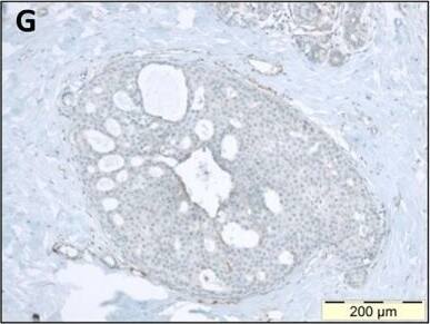 Immunohistochemistry: Versican Antibody [NBP1-85432] - Immunohistochemical staining of stromal protein expression in DCIS with sclerotic or myxoid stromaMicrophotographs displaying HE staining (A-B), & IHC staining for biglycan (C-D), decorin (E-F) & versican (G-H). Panels A-C-E-G display photographs of one DCIS lesion with sclerotic stroma; panels B-D-F-H display one DCIS lesion with myxoid stroma. This figure illustrates that myxoid DCIS present reduced periductal decorin staining & tend to have increased periductal versican & biglycan expression, whereas sclerotic DCIS generally present strong stromal decorin immunoreactivity, & tend to lack stromal versican & biglycan. Original magnification 100x. Image collected & cropped by CiteAb from the following publication (//www.oncoscience.us/lookup/doi/10.18632/oncoscience.87), licensed under a CC-BY license. Not internally tested by Novus Biologicals.