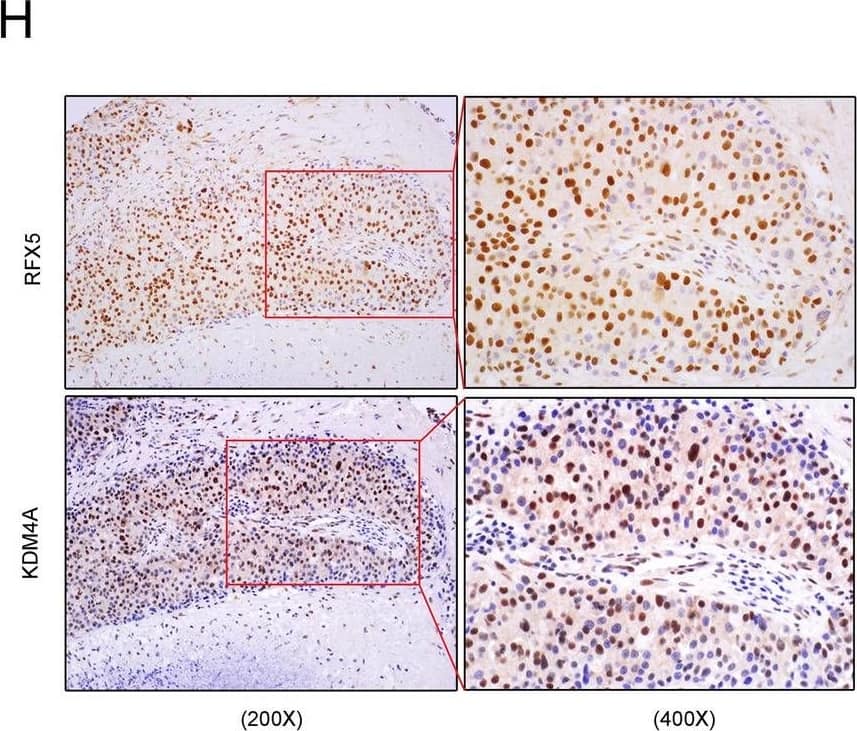 Immunohistochemistry: RFX5 Antibody [NBP1-86041] - RFX5 is a positive regulator of KDM4A expression in HCC. IHC staining of RFX5 and KDM4A in the same cancer nest. The cellular localization and distribution patterns of KDM4A protein were highly consistent with that of RFX5 protein in the continuous sections of the same cancer nest. Image collected and cropped by CiteAb from the following publication (//pubmed.ncbi.nlm.nih.gov/32883983/), licensed under a CC-BY license.