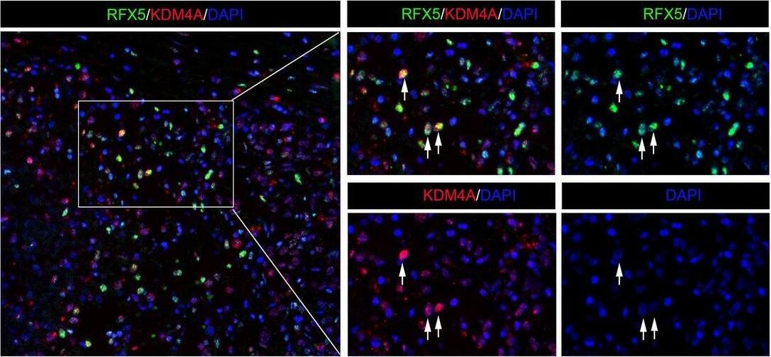 RFX5 is a positive regulator of KDM4A expression in HCC. (A) KDM4A expression levels were assessed in FLAG-RFX5-transfected HepG2 cells via QRT-PCR analysis. (B) KDM4A expression levels were assessed in shRNA targeting RFX5-transfected HepG2 cells via QRT-PCR analysis. (C) KDM4A protein expression levels were determined in MHCC-97H and HepG2 cells transduced with lentiviral FLAG-RFX5 or sgRNA targeting RFX5 via Western blot analysis. (D) The correlation between RFX5 and KDM4A mRNA expressions in HCC patients derived from TCGA LIHC dataset. (E) The correlation of KDM4A protein expression status determined by IHC analysis with overall survival time (OST). (F) The correlation of KDM4A mRNA expression level determined by RNAseq in TCGA LIHC dataset with OST. (G) Immunohistochemistry analysis was used to quantify the amount of KDM4A protein in HCC tumor tissues and adjacent non-tumor tissues was determined (N−, less than 5% of tumor cells stained positive; N+, 5–30% of tumor cells stained positive; N++, 31–50% of tumor cells stained positive; N+++, > 51% of tumor cells stained positive.). (H) IHC staining of RFX5 and KDM4A in the same cancer nest. (I) The co-expression of RFX5 and KDM4A in HCC tissues was determined by the immunofluorescence staining. The white arrows pointed HCC cells which co-expressed RFX5 and KDM4A. Image collected and cropped by CiteAb from the following open publication (//pubmed.ncbi.nlm.nih.gov/32883983), licensed under a CC-BY license. Not internally tested by Novus Biologicals.