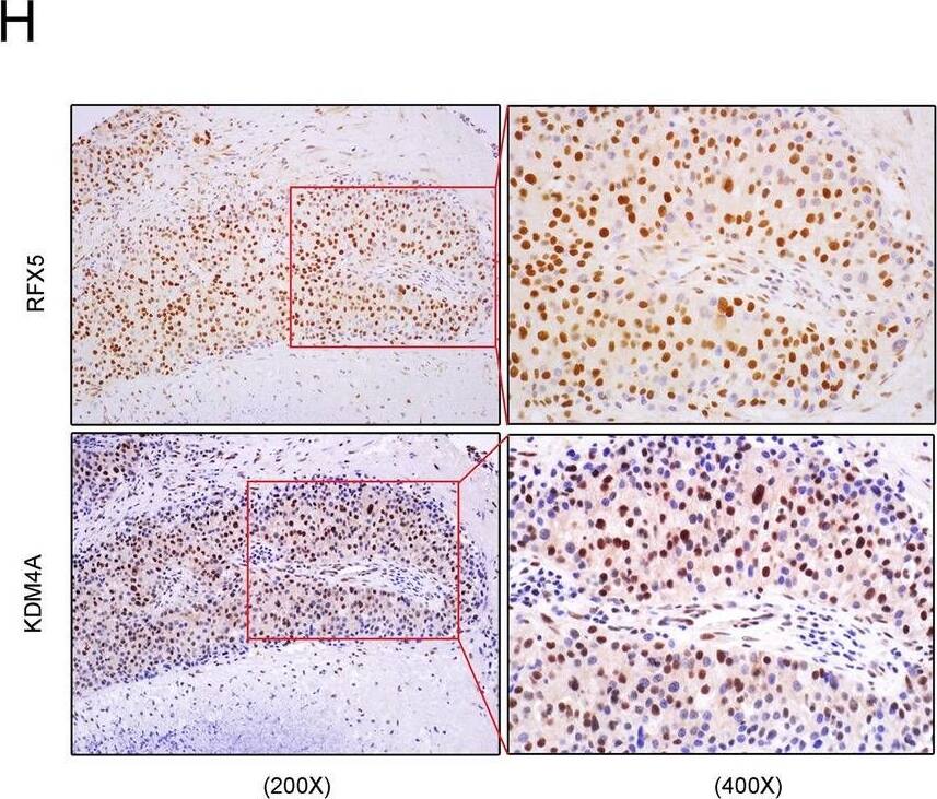 RFX5 is a positive regulator of KDM4A expression in HCC. (A) KDM4A expression levels were assessed in FLAG-RFX5-transfected HepG2 cells via QRT-PCR analysis. (B) KDM4A expression levels were assessed in shRNA targeting RFX5-transfected HepG2 cells via QRT-PCR analysis. (C) KDM4A protein expression levels were determined in MHCC-97H and HepG2 cells transduced with lentiviral FLAG-RFX5 or sgRNA targeting RFX5 via Western blot analysis. (D) The correlation between RFX5 and KDM4A mRNA expressions in HCC patients derived from TCGA LIHC dataset. (E) The correlation of KDM4A protein expression status determined by IHC analysis with overall survival time (OST). (F) The correlation of KDM4A mRNA expression level determined by RNAseq in TCGA LIHC dataset with OST. (G) Immunohistochemistry analysis was used to quantify the amount of KDM4A protein in HCC tumor tissues and adjacent non-tumor tissues was determined (N−, less than 5% of tumor cells stained positive; N+, 5–30% of tumor cells stained positive; N++, 31–50% of tumor cells stained positive; N+++, > 51% of tumor cells stained positive.). (H) IHC staining of RFX5 and KDM4A in the same cancer nest. (I) The co-expression of RFX5 and KDM4A in HCC tissues was determined by the immunofluorescence staining. The white arrows pointed HCC cells which co-expressed RFX5 and KDM4A. Image collected and cropped by CiteAb from the following open publication (//pubmed.ncbi.nlm.nih.gov/32883983), licensed under a CC-BY license. Not internally tested by Novus Biologicals.