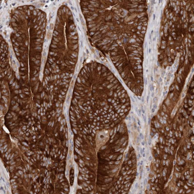 Staining of human colorectal cancer shows strong positivity in tumor cells.