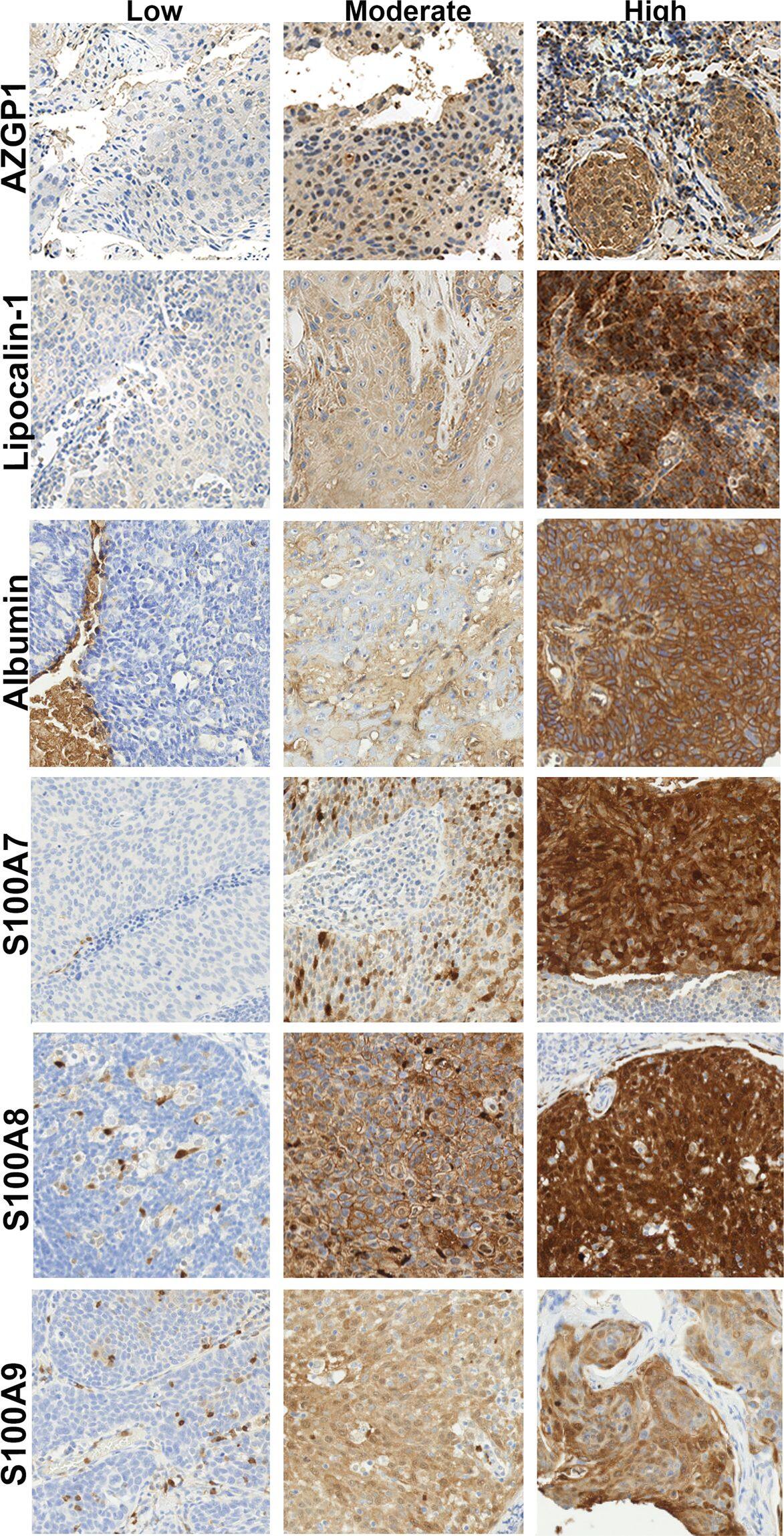 Immunohistochemistry: S100A7/Psoriasin Antibody [NBP1-87205] - Zn-binding protein immunohistochemical staining in OPSCC. Examples from nanozoomer digitized scans (20X magnification) of low, moderate & high cytoplasmic staining of OPSCC tumor tissue for the Zn-binding proteins AZGP1, Lipocalin-1, serum Albumin, S100A7, S100A8 & S100A9. Image collected & cropped by CiteAb from the following publication (//pubmed.ncbi.nlm.nih.gov/31740720), licensed under a CC-BY license. Not internally tested by Novus Biologicals.