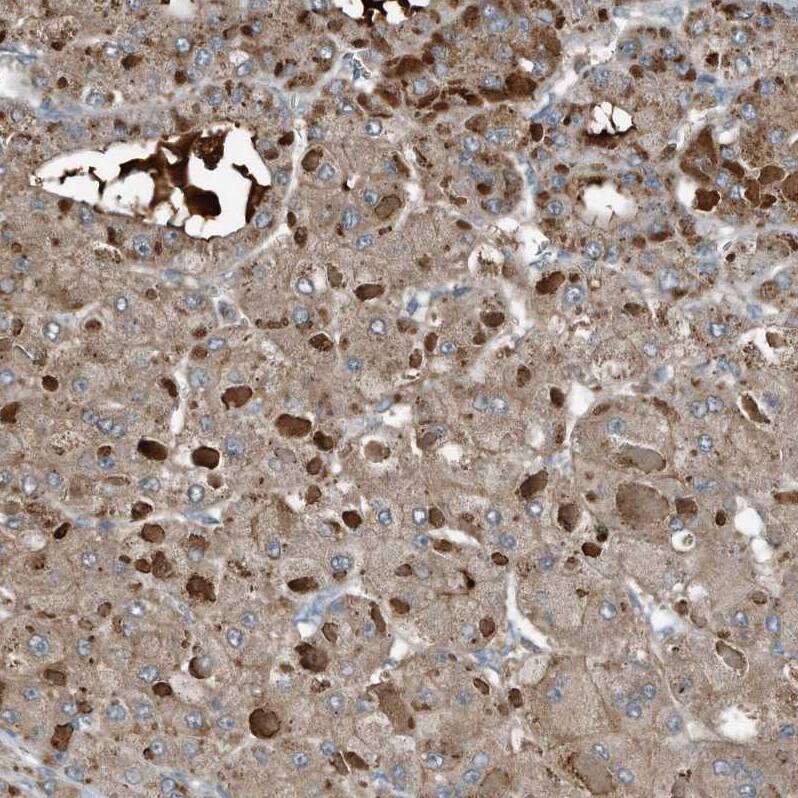 Staining of human Liver cancer shows strong extracellular space and cytoplasmic positivity in tumor cells.