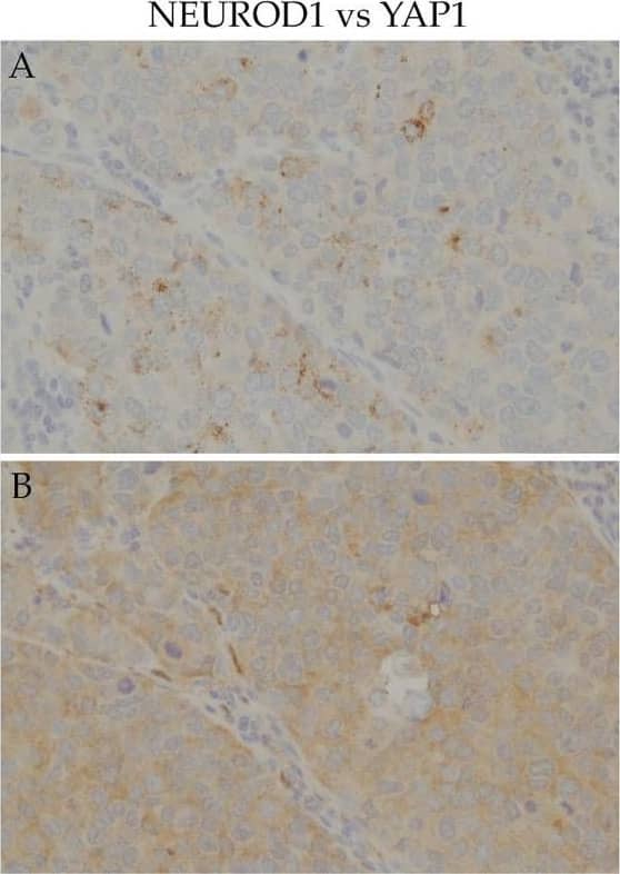 Immunohistochemistry: NeuroD1 Antibody [NBP1-88661] - IHC of the co-expression of key molecules other than ASCL1 in SCLC samples. Serial section immunostaining for NEUROD1 (A) & YAP1 (B): SCLC cell nuclei were positive for NEUROD1 (A), & the cytoplasm was positive for YAP1 (B). Serial section immunostaining for NEUROD1 (C) & POU2F31 (D): SCLC cell nuclei were positive for NEUROD1 (C), & the cytoplasm was positive for POU2F3 (D). The cytoplasm of SCLC cells was positive for YAP1 (E) & POU2F3 (F). Scale bar = 100 μm. Image collected & cropped by CiteAb from the following publication (//pubmed.ncbi.nlm.nih.gov/33202998), licensed under a CC-BY license. Not internally tested by Novus Biologicals.