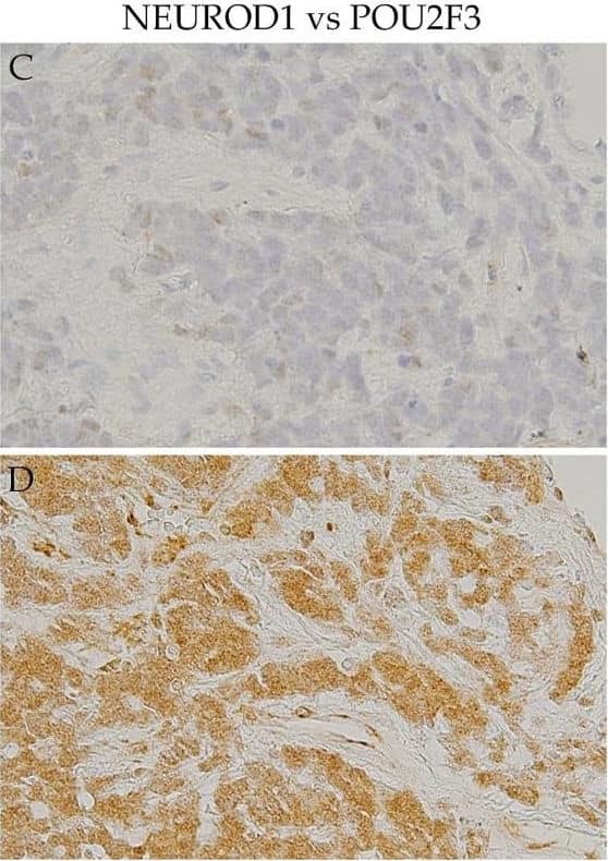 Immunohistochemistry: NeuroD1 Antibody [NBP1-88661] - IHC of the co-expression of key molecules other than ASCL1 in SCLC samples. Serial section immunostaining for NEUROD1 (A) & YAP1 (B): SCLC cell nuclei were positive for NEUROD1 (A), & the cytoplasm was positive for YAP1 (B). Serial section immunostaining for NEUROD1 (C) & POU2F31 (D): SCLC cell nuclei were positive for NEUROD1 (C), & the cytoplasm was positive for POU2F3 (D). The cytoplasm of SCLC cells was positive for YAP1 (E) & POU2F3 (F). Scale bar = 100 μm. Image collected & cropped by CiteAb from the following publication (//pubmed.ncbi.nlm.nih.gov/33202998), licensed under a CC-BY license. Not internally tested by Novus Biologicals.