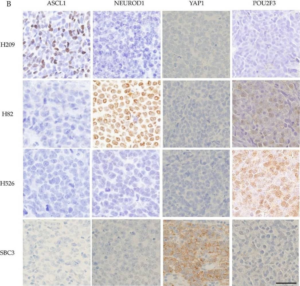 Immunohistochemistry: NeuroD1 Antibody [NBP1-88661] - Example of the positive control of four key molecules by WB & IHC in SCLC samples. (A) Example of the positive control of the four key molecules by WB in SCLC cell lines. ASCL1 was strongly expressed in H209 cells. NeuroD1 was strongly expressed in H82 cells. Pou2F3 was strongly expressed in H526 cells & weakly expressed in H82 & SBC3 cells. YAP1 was strongly expressed in SBC3 cells.  beta -actin served as an internal control. (B) Example of the positive control of the four key molecules in xenotransplanted tumor tissues from the four cell lines in mice by IHC. ASCL1 staining was found in tumor cell nuclei of H209 cells. NeuroD1 staining was found in the tumor cell nuclei of H82 cells. Pou2F3 staining with a diffuse cytoplasmic pattern was found in H82, H526, & SBC3 cells. The Pou2F3 staining intensity was weak in H82 & SBC3 cells & strong in H526 cells. YAP1 was stained with a membranous pattern in SBC3 cells. Scale bar = 50 μm. Image collected & cropped by CiteAb from the following publication (//pubmed.ncbi.nlm.nih.gov/33202998), licensed under a CC-BY license. Not internally tested by Novus Biologicals.