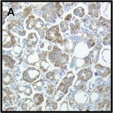 Immunohistochemistry: CIAPIN1 Antibody [NBP1-89097] - Ciapin1 protein expression by immunohistochemistry. (A-B) Diffuse Ciapin1 expression (>75% of tumor cells) in the cytoplasm of OC cells in 2 effusions; (C) Focal expression (<5%) in another specimen; (D) Nuclear localization of Ciapin1, an unusual finding in this series. Image collected & cropped by CiteAb from the following publication (//pubmed.ncbi.nlm.nih.gov/25889687), licensed under a CC-BY license. Not internally tested by Novus Biologicals.