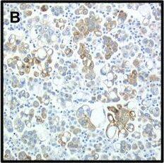 Immunohistochemistry: CIAPIN1 Antibody [NBP1-89097] - Ciapin1 protein expression by immunohistochemistry. (A-B) Diffuse Ciapin1 expression (>75% of tumor cells) in the cytoplasm of OC cells in 2 effusions; (C) Focal expression (75% of tumor cells) in the cytoplasm of OC cells in 2 effusions; (C) Focal expression (75% of tumor cells) in the cytoplasm of OC cells in 2 effusions; (C) Focal expression (75% of tumor cells) in the cytoplasm of OC cells in 2 effusions; (C) Focal expression (75% of tumor cells) in the cytoplasm of OC cells in 2 effusions; (C) Focal expression (<5%) in another specimen; (D) Nuclear localization of Ciapin1, an unusual finding in this series. Image collected & cropped by CiteAb from the following publication (//pubmed.ncbi.nlm.nih.gov/25889687), licensed under a CC-BY license. Not internally tested by Novus Biologicals.
