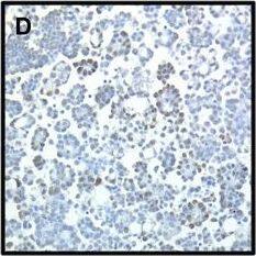 Immunohistochemistry: CIAPIN1 Antibody [NBP1-89097] - Ciapin1 protein expression by immunohistochemistry. (A-B) Diffuse Ciapin1 expression (>75% of tumor cells) in the cytoplasm of OC cells in 2 effusions; (C) Focal expression (<5%) in another specimen; (D) Nuclear localization of Ciapin1, an unusual finding in this series. Image collected & cropped by CiteAb from the following publication (//pubmed.ncbi.nlm.nih.gov/25889687), licensed under a CC-BY license. Not internally tested by Novus Biologicals.