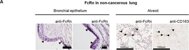 Expression of FcRn in non-cancerous A. and cancerous B. serial lung sections from a small set of patients (n=8)(A) FcRn expression was very week in bronchial epithelial cells (left panel) and marked in alveolar macrophages (right panel) in the non-cancerous lung. (B) In cancerous tissue, the staining revealed that FcRn is expressed in interstitial stromal cells including DCs (PS100), macrophages (CD163) (arrowheads indicate areas of colocalization) but no CD8+ T cells (CD8). A very weak staining was also observed in carcinomatous cells. Pictures from 3 patients were selected as they are representative of the different staining. Image collected and cropped by CiteAb from the following open publication (//pubmed.ncbi.nlm.nih.gov/27384673), licensed under a CC-BY license. Not internally tested by Novus Biologicals.