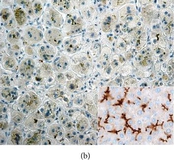 Immunohistochemistry: ABCB11 Antibody [NBP1-89319] - Histopathology of ABCB11 disease. (a) Giant-cell hepatitis (arrows) with hepatocanalicular cholestasis & (b) complete absence of ABCB11/BSEP protein are typical findings in PFIC2 patients. Inset: immunohistochemical positivity of BSEP in the apical (canalicular) domain of hepatocytes in a healthy control. (a) Hematoxylin & eosin, original magnification x200. (b, inset) Immunohistochemical staining with ABCB11 Rabbit Polyclonal Antibody (NBP1-89319, Novus Biologicals, USA), original magnification x200 (b), x400 (inset). Image collected & cropped by CiteAb from the following publication (//pubmed.ncbi.nlm.nih.gov/30148122), licensed under a CC-BY license. Not internally tested by Novus Biologicals.