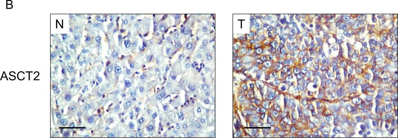 Significantly elevated GLUT1 and ASCT2 expression levels in hepatocellular carcinoma (HCC).(A–B) Immunohistochemistry (IHC) assays of GLUT1 (A) and ASCT2 (B) expression in tumor (T) and adjacent non-tumor tissues (N). The scale bar indicates 50 μm. (C-D) GLUT1 (C) and ASCT2 (D) expression levels in tumor (T) tissue are significantly higher than those in adjacent non-tumor tissue (N) (n = 15). The IHC H-scores are shown as a box-plot; ** indicates p < 0.01. Image collected and cropped by CiteAb from the following open publication (//pubmed.ncbi.nlm.nih.gov/28036362), licensed under a CC-BY license. Not internally tested by Novus Biologicals.