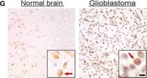 TRIM8 is expressed in GBM samples and neurosphere cells. (A–C) Gene expression correlation of TRIM8 with STAT3,SOX2, and NESTIN using U133 mRNA data from TCGA. TRIM8 vs STAT3: Pearson's correlation coefficient: r = 0.36, P < 0.00001. TRIM8 vs SOX2: Pearson's correlation coefficient: r = 0.22, P < 0.00001. TRIM8 vs NESTIN: Pearson's correlation coefficient: r = 0.22, P < 0.00001. (D) Schematic representation of TRIM8 protein with RING, B‐box, and coiled‐coil domains. (E) TRIM8 copy number variation among 577 GBM samples in TCGA dataset. TRIM8 shows hemizygous deletion in 88.04% of cases. (F) Western blot analysis of TRIM8 protein among six normal human brain tissues (N1–N6) and five GBMs (G1–G5). (G) Immunohistochemical (IHC) staining of TRIM8 in normal brain and GBM tissues. TRIM8 (+) cells (indicated by arrow) are predominantly neurons in the normal brain and show cytoplasmic staining. TRIM8 expression in GBM is predominant in nuclei of tumor cells with modest cytoplasmic staining. Sections were counterstained with hematoxylin. Scale bar = 10 μm. (H) Reverse transcription PCR analysis and western blot analysis of TRIM8 among two normal cell lines and six patient‐derived GBM neurosphere cells. NHNP = normal human neural progenitor cell. (I) Immunocytochemical (ICC) staining of TRIM8 in neurosphere cells showing nuclear expression of TRIM8. TRIM8 was labeled in GFP, and nuclei were counterstained with DAPI (blue). Scale bar = 10 μm. Image collected and cropped by CiteAb from the following open publication (//pubmed.ncbi.nlm.nih.gov/28100038), licensed under a CC-BY license. Not internally tested by Novus Biologicals.