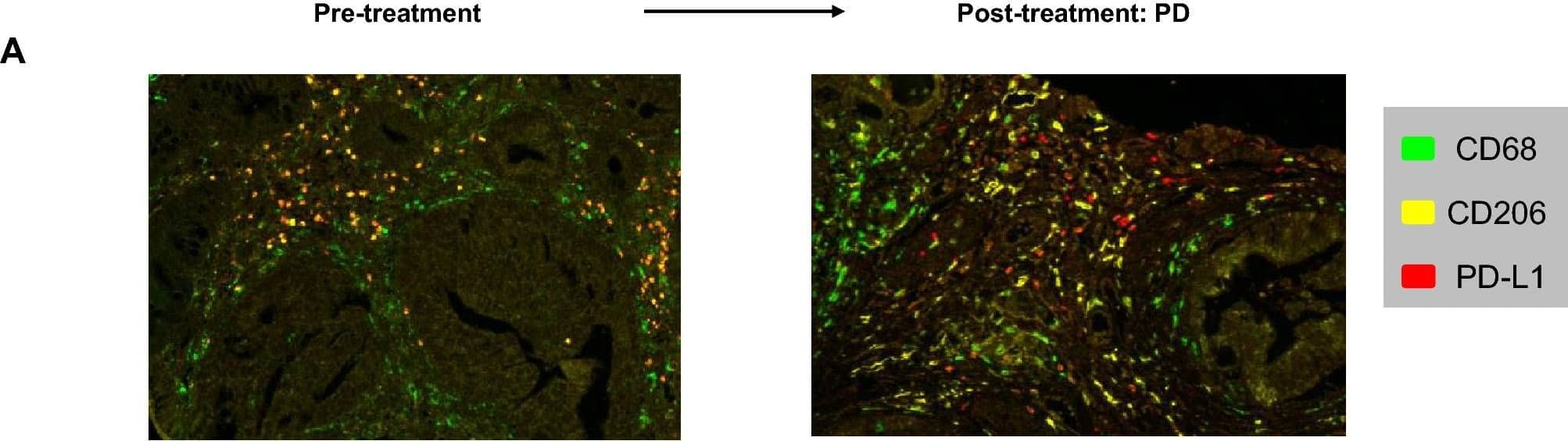 Dynamic changes of the density of the M2 macrophages according to different clinical settings. (A) Representative scans of multiplexed immunohistochemistry showing dynamic changes of CD68, CD206 and PD-L1 between pre-treatment tumor and post-treatment tumor with progressive disease. (B–E) Dynamic changes in the density in the following immune subsets according to the clinical response: (B) CD68+CD206+ M2 macrophages; (C) PD-L1+ CD68+CD206+ M2 macrophages; (D) CD68+CD206− macrophages; and (E) PD-L1+ CD68+CD206− macrophages. Image collected and cropped by CiteAb from the following open publication (//pubmed.ncbi.nlm.nih.gov/35102212), licensed under a CC-BY license. Not internally tested by Novus Biologicals.