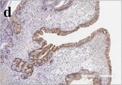 Immunohistochemistry: Annexin A10 Antibody [NBP1-90156] - Histological & immunohistochemical staining of type A2 TSAs. a HE staining. b A high-power view showing the TSA component (red box in Fig. 2a). c A high-power view showing the precursor component (blue box in Fig. 2a). d Positive for annexin A10 expression. e Positive for MUC2 expression. f Positive for MUC5AC expression. g Negative for MUC6 expression. h Negative for CD10 expression. i Positive for annexin A10 expression. j Positive for MUC2 expression. k Positive for MUC5AC expression. l Negative for MUC6 expression. m Negative for CD10 expression Image collected & cropped by CiteAb from the following publication (//pubmed.ncbi.nlm.nih.gov/32535664), licensed under a CC-BY license. Not internally tested by Novus Biologicals.