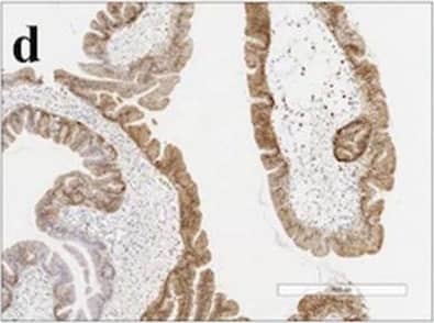 Immunohistochemistry: Annexin A10 Antibody [NBP1-90156] - Histological & immunohistochemical staining of type A1 TSAs. a HE staining. b A high-power view showing the TSA component (red box in Fig. 1a). c A high-power view showing the precursor component (blue box in Fig. 1a). d Positive for annexin A10 expression. e Positive for MUC2 expression. f Partially positive for MUC5AC expression. g Negative for MUC6 expression. h Negative for CD10 expression. i Negative for annexin A10 expression. j Positive for MUC2 expression. k Positive for MUC5AC expression. l Negative for MUC6 expression. m Negative for CD10 expression Image collected & cropped by CiteAb from the following publication (//pubmed.ncbi.nlm.nih.gov/32535664), licensed under a CC-BY license. Not internally tested by Novus Biologicals.