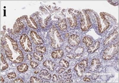 Immunohistochemistry: Annexin A10 Antibody [NBP1-90156] - Histological & immunohistochemical staining of type A2 TSAs. a HE staining. b A high-power view showing the TSA component (red box in Fig. 2a). c A high-power view showing the precursor component (blue box in Fig. 2a). d Positive for annexin A10 expression. e Positive for MUC2 expression. f Positive for MUC5AC expression. g Negative for MUC6 expression. h Negative for CD10 expression. i Positive for annexin A10 expression. j Positive for MUC2 expression. k Positive for MUC5AC expression. l Negative for MUC6 expression. m Negative for CD10 expression Image collected & cropped by CiteAb from the following publication (//pubmed.ncbi.nlm.nih.gov/32535664), licensed under a CC-BY license. Not internally tested by Novus Biologicals.