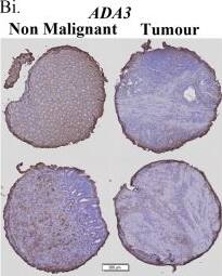 PCAF, ADA3, and PACS1 protein expression is reduced in human gastric tumor tissue.A tissue microarray (TMA) containing gastric tumor tissue (Tumor) and non-malignant gastric tissue (NM), was immunostained for a PCAF, b ADA3, and c PACS1. Data are presented as percentage positive stained area (%+’ve) quantitated by normalizing the relative intensity for each protein to that of the respective control IgG. The process for determining each experimental value in the plots was automated, using MetaMorph® image analysis software (MetaMorph Inc., USA). i Two representative sets of tissue samples for each of the three antigens under study (PCAF, ADA3, PACS1), comparing non-malignant and malignant tumor tissue. ii Whisker plots comparing pooled data across the entire cohort for non-malignant (NM) versus malignant tissue sections. iii Pairwise analysis for TMA %+’ve stained area for gastric tumor tissue to patient matched non-malignant gastric tissue. Error bars are S.E.M., statistical analysis performed: t-test, *p < 0.05, **p < 0.01 and ***p < 0.001 Image collected and cropped by CiteAb from the following open publication (//pubmed.ncbi.nlm.nih.gov/29670108), licensed under a CC-BY license. Not internally tested by Novus Biologicals.