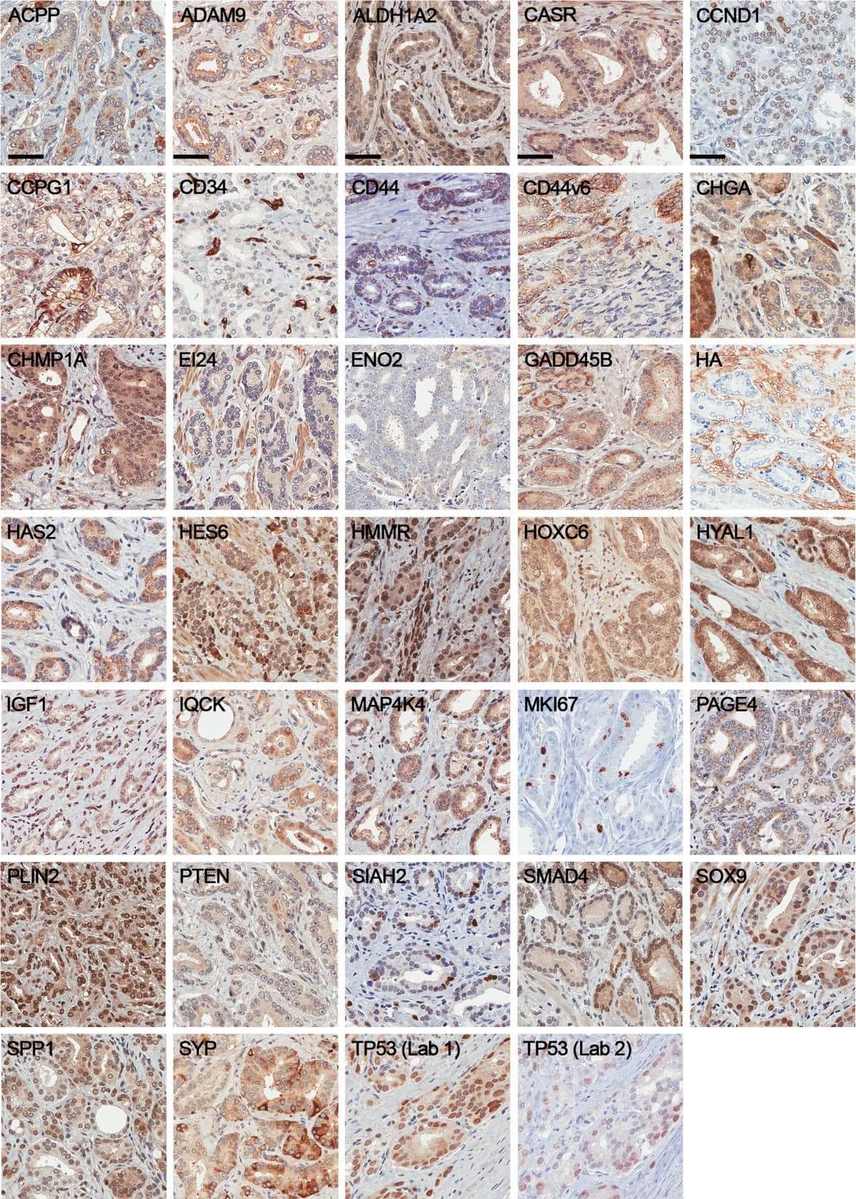 Immunohistochemistry of candidate biomarkers in prostate cancer. Representative immunohistochemical staining of ACPP, ADAM9, ALDH1A2, CASR, CCND1, CCPG1, CD34, CD44, CD44v6, CHGA, CHMP1A, EI24, ENO2, GADD45B, HA, HAS2, HES6, HMMR, HOXC6, HYAL1, IGF1, IQCK, MAP4K4, MKI67, PAGE4, PLIN2, PTEN, SIAH2, SMAD4, SOX9, SPP1, SYP, & TP53 from prostate cancer tissue microarrays. Scale bar represents 50 μm. Image collected & cropped by CiteAb from the following publication (//bmccancer.biomedcentral.com/articles/10.1186/1471-2407-14-244), licensed under a CC-BY license. Not internally tested by Novus Biologicals.