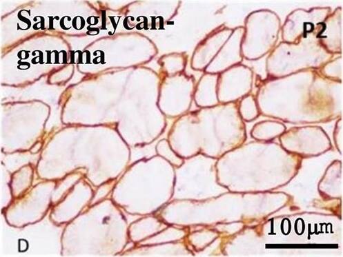 Immunohistochemistry using antibodies against Dystrophin, Sarcoglycan-alpha, Sarcoglycan-beta, Sarcoglycan-gamma and Dysferlin showing normal expression in myofibres (a: Dystrophin x 20X, b: Sarcoglycan-alpha x 40X, c: Sarcoglycan-beta x 20X, d: Sarcoglycan-gamma x 40X, e: Dysferlin x 40X) Image collected and cropped by CiteAb from the following open publication (//ojrd.biomedcentral.com/articles/10.1186/s13023-024-03158-1), licensed under a CC-BY license. Not internally tested by Novus Biologicals.